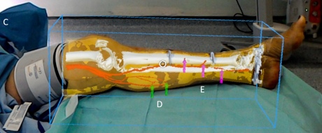 Leg surgery supported by augmented reality